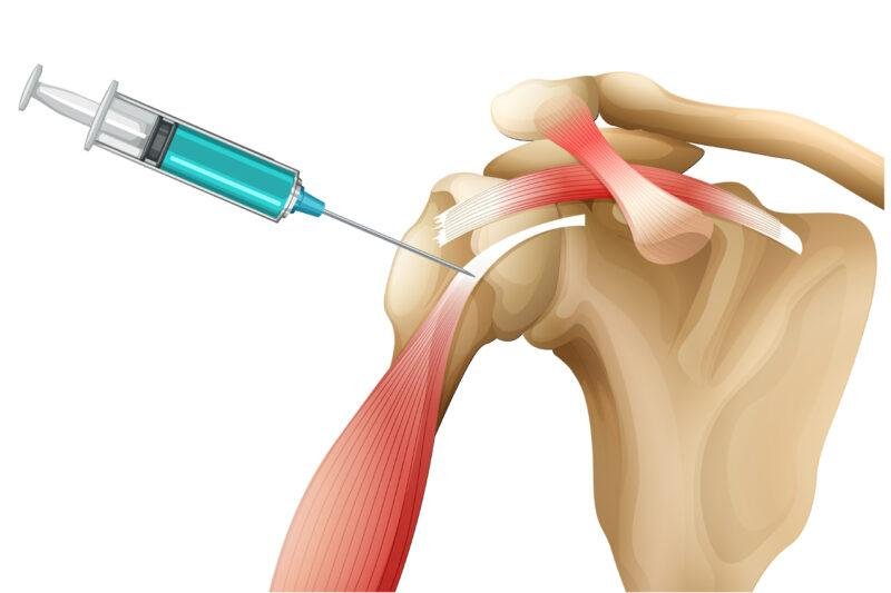 Steroids vs Prolotherapy IntraArticular Steroid Injection