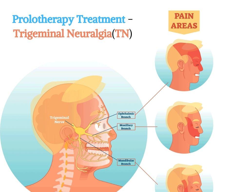 Trigeminal-Neuralgia- Treatment-in-Pune