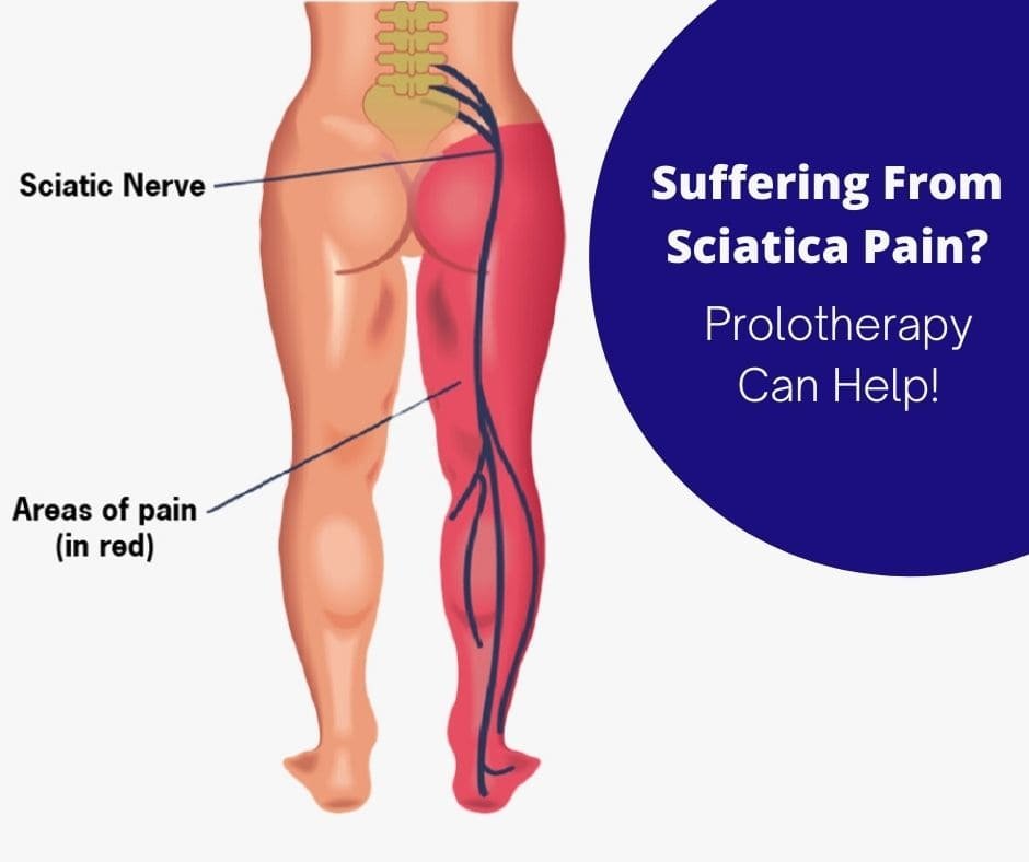 Sciatic Nerve Pain