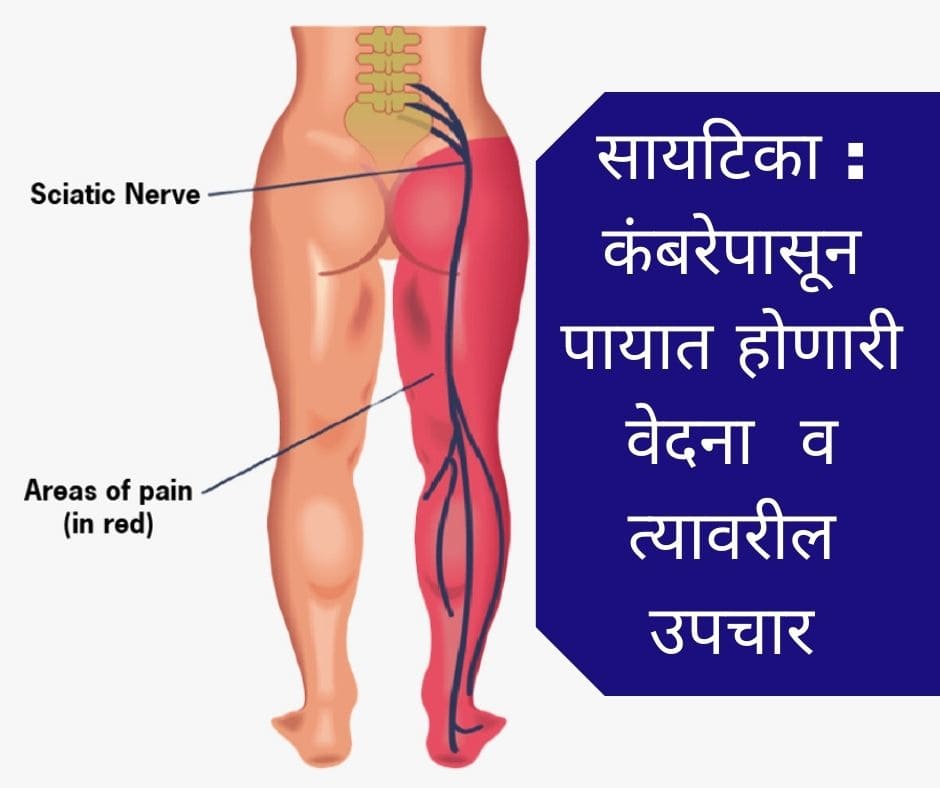 Scatica-pain-treatment-in-pune