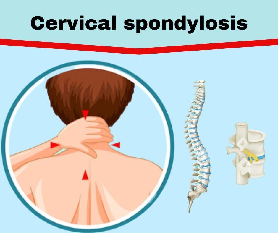 What Is Cervical Spondylosis The Prolotherapy Clinic