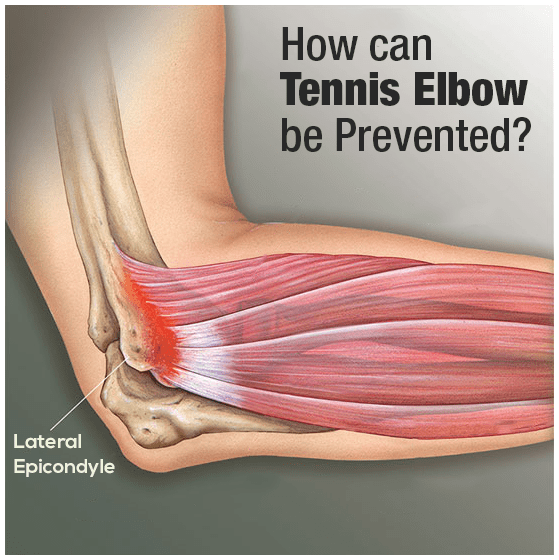 How-can-tennis-elbow-be-prevented
