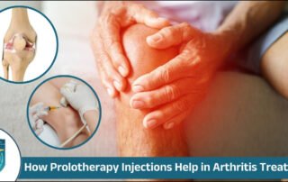 Prolotherapy Injections for Arthritis