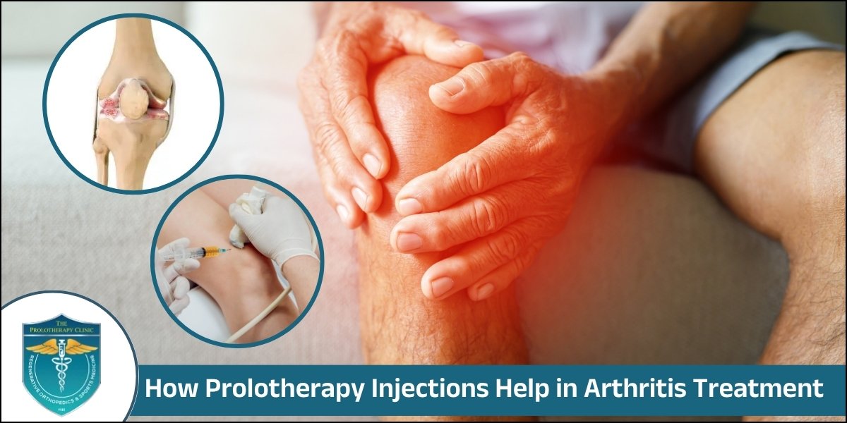Prolotherapy Injections for Arthritis